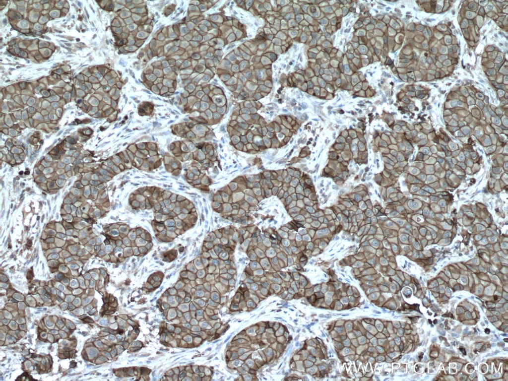 Immunohistochemistry (IHC) staining of human breast cancer tissue using S100A14 Polyclonal antibody (10489-1-AP)