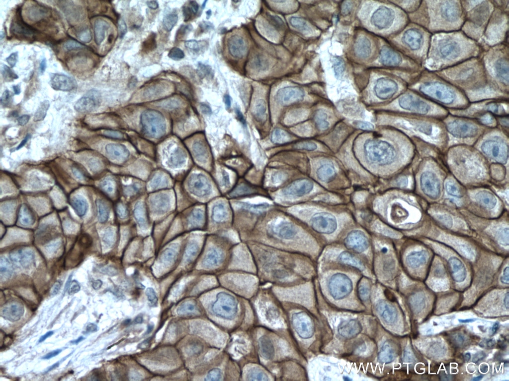 Immunohistochemistry (IHC) staining of human breast cancer tissue using S100A14 Polyclonal antibody (10489-1-AP)