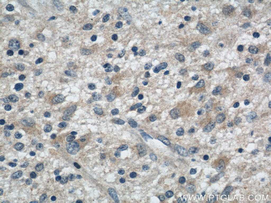 Immunohistochemistry (IHC) staining of human gliomas tissue using S100A14 Polyclonal antibody (10489-1-AP)