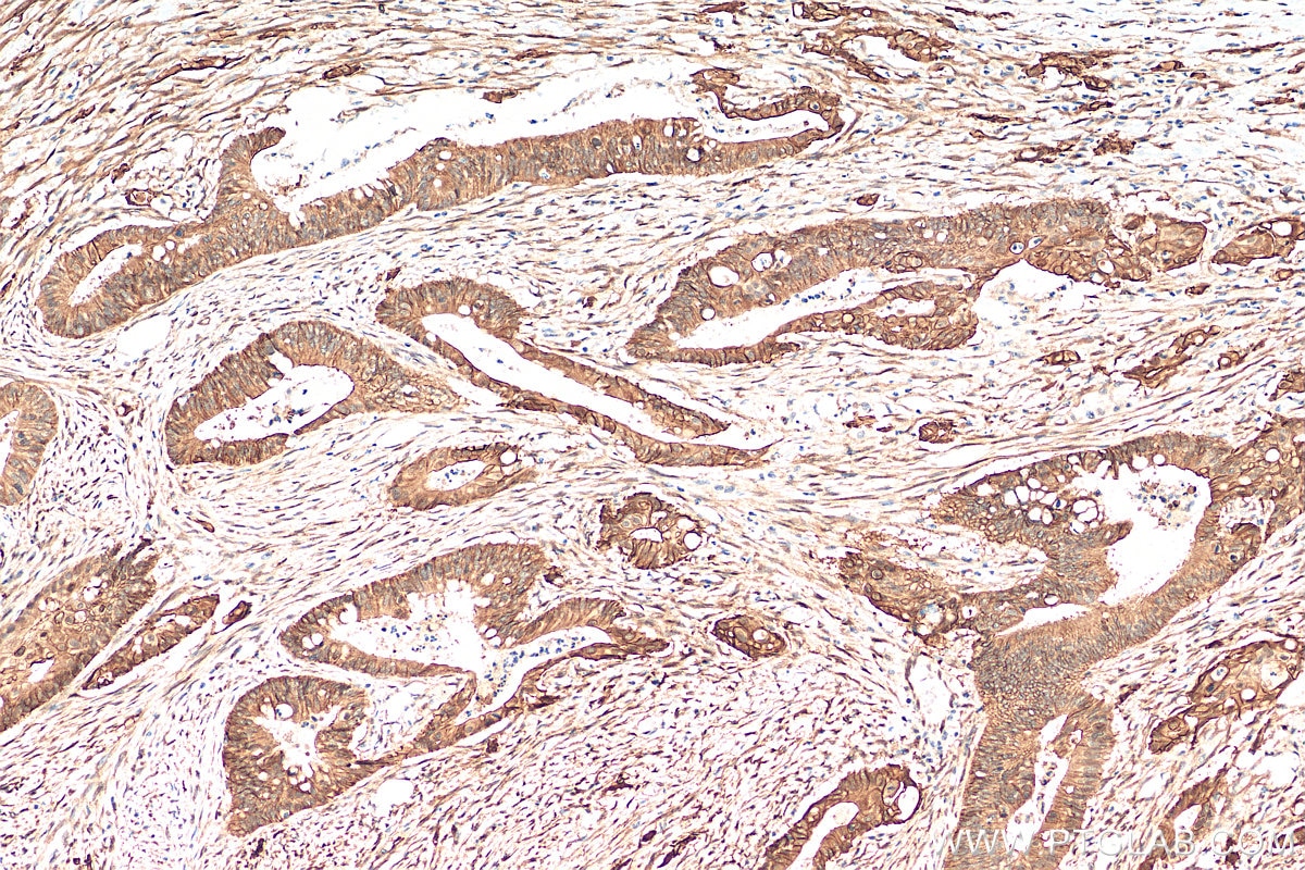 Immunohistochemistry (IHC) staining of human colon cancer tissue using S100A16 Polyclonal antibody (11456-1-AP)