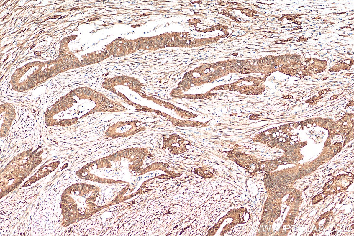 Immunohistochemistry (IHC) staining of human colon cancer tissue using S100A16 Polyclonal antibody (11456-1-AP)
