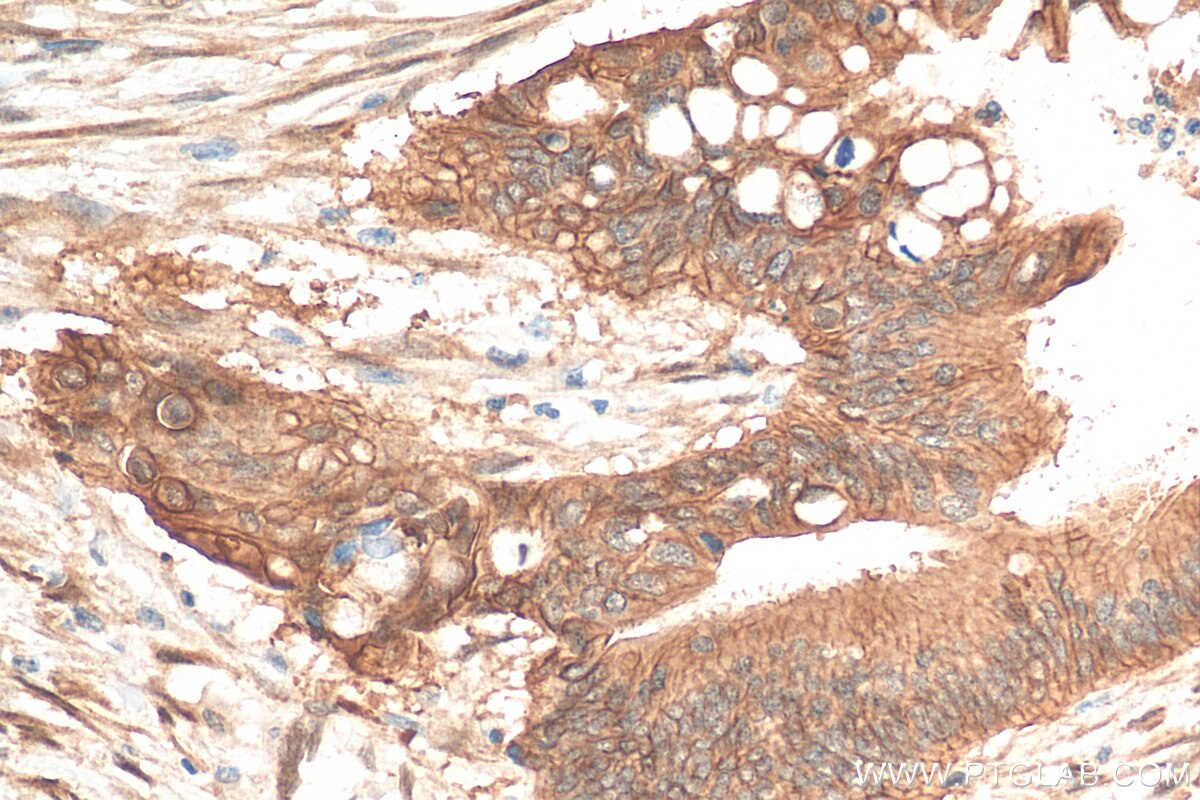 Immunohistochemistry (IHC) staining of human colon cancer tissue using S100A16 Polyclonal antibody (11456-1-AP)