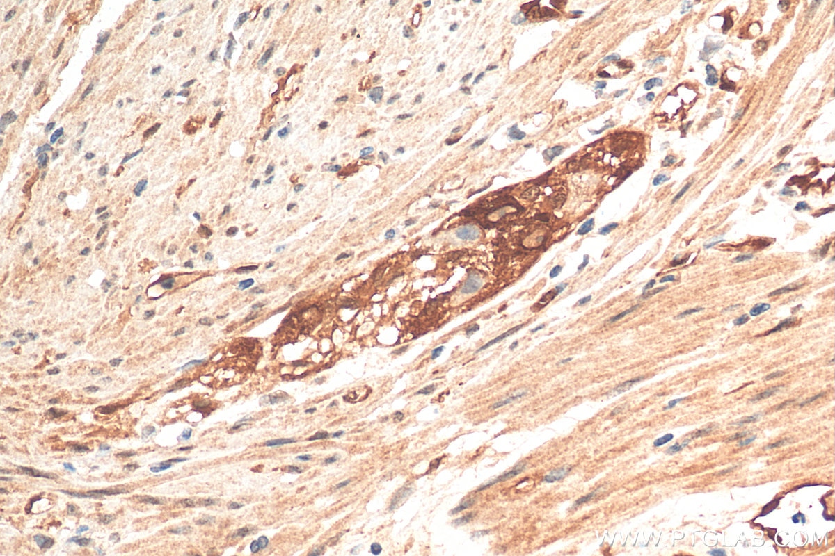 IHC staining of human colon cancer using 11456-1-AP