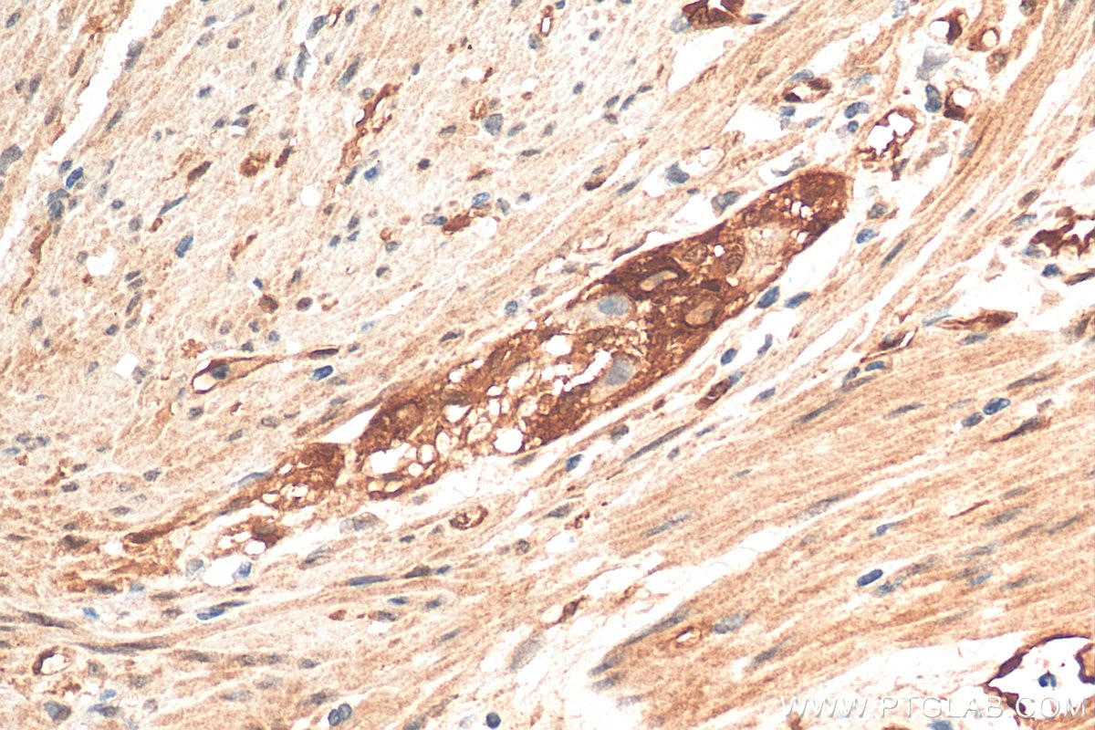 Immunohistochemistry (IHC) staining of human colon cancer tissue using S100A16 Polyclonal antibody (11456-1-AP)