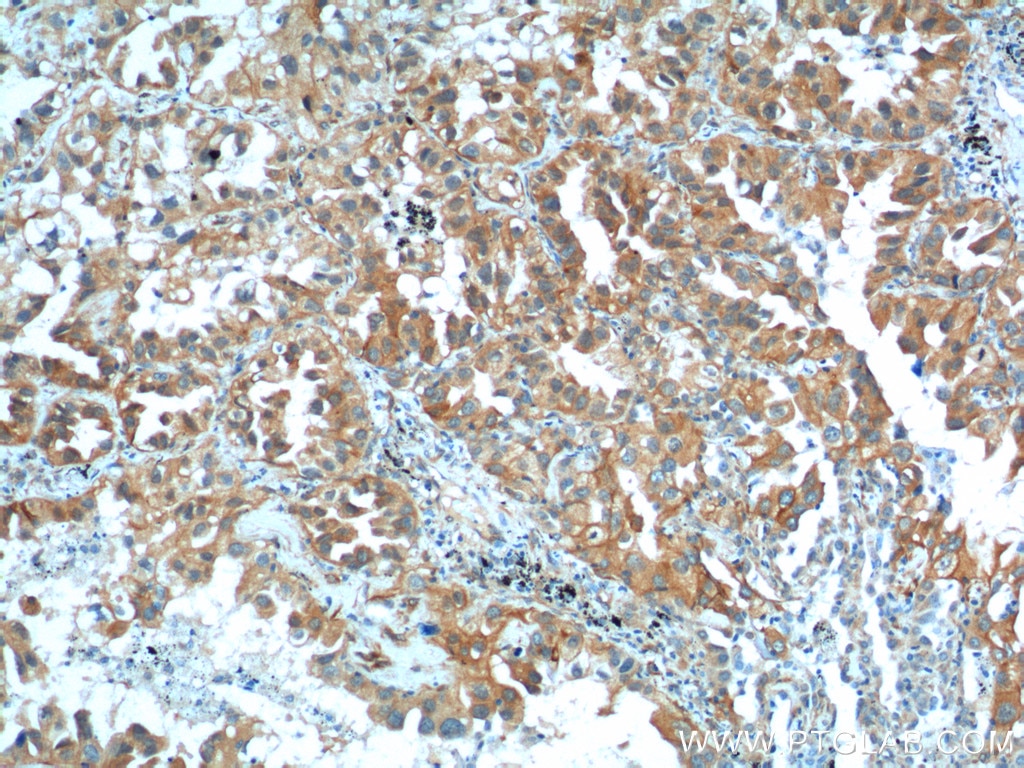 Immunohistochemistry (IHC) staining of human lung cancer tissue using S100A16 Polyclonal antibody (11456-1-AP)