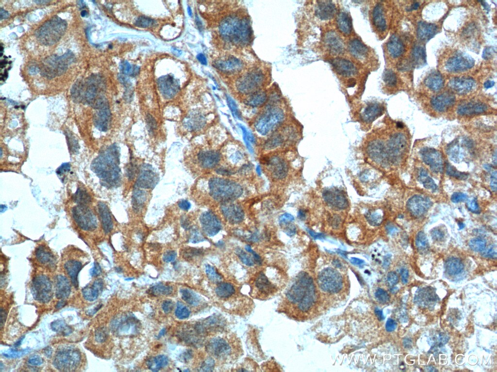 Immunohistochemistry (IHC) staining of human lung cancer tissue using S100A16 Polyclonal antibody (11456-1-AP)