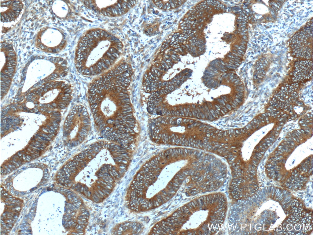 Immunohistochemistry (IHC) staining of human colon cancer tissue using S100A16 Polyclonal antibody (11456-1-AP)