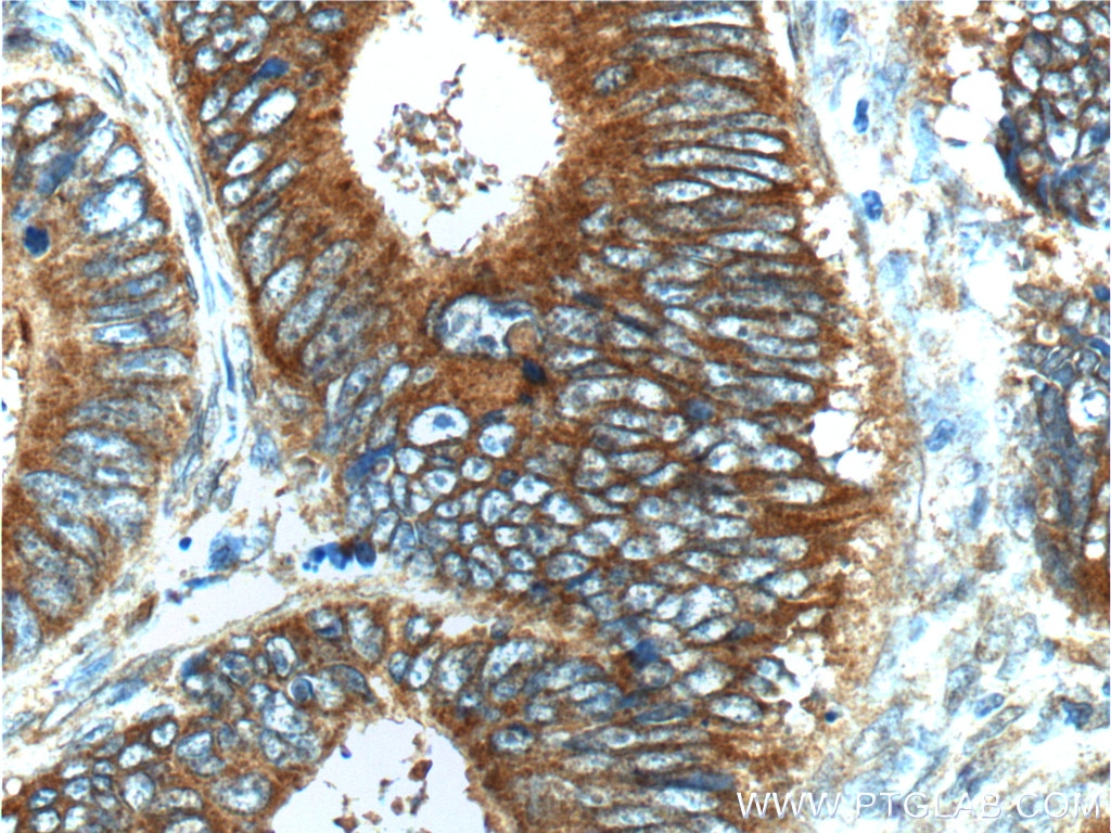 Immunohistochemistry (IHC) staining of human colon cancer tissue using S100A16 Polyclonal antibody (11456-1-AP)