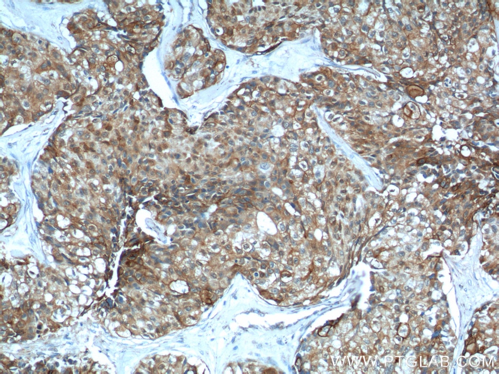 Immunohistochemistry (IHC) staining of human lung cancer tissue using S100A16 Polyclonal antibody (11456-1-AP)
