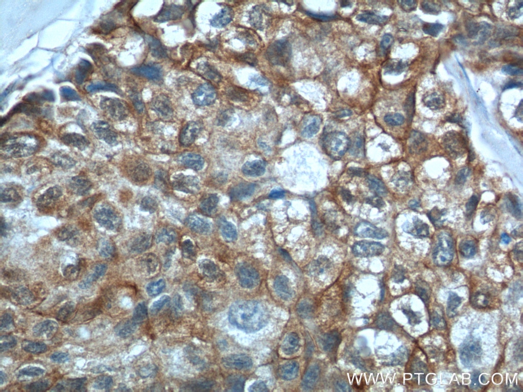 Immunohistochemistry (IHC) staining of human lung cancer tissue using S100A16 Polyclonal antibody (11456-1-AP)