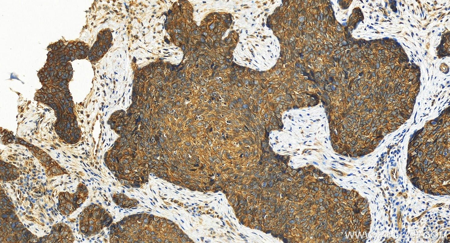 Immunohistochemistry (IHC) staining of human bowen disease using S100A16 Polyclonal antibody (11456-1-AP)