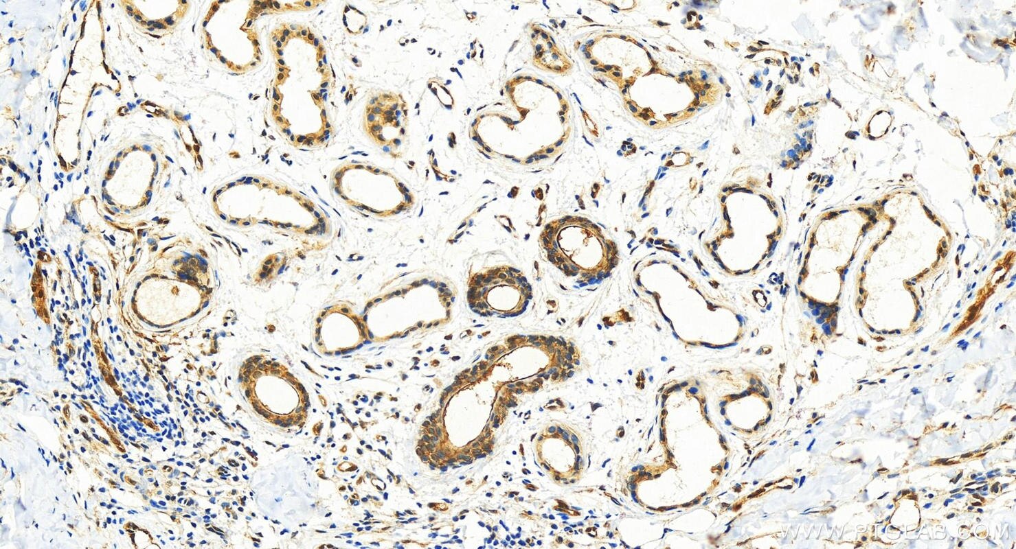 Immunohistochemistry (IHC) staining of human bowen disease using S100A16 Polyclonal antibody (11456-1-AP)