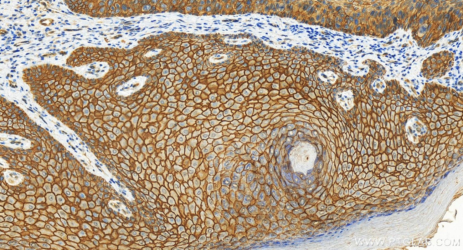 Immunohistochemistry (IHC) staining of human bowen disease using S100A16 Polyclonal antibody (11456-1-AP)