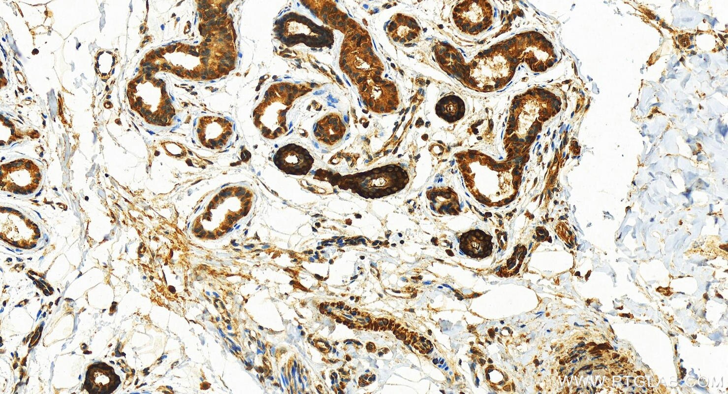 Immunohistochemistry (IHC) staining of human bowen disease using S100A2 Polyclonal antibody (15454-1-AP)