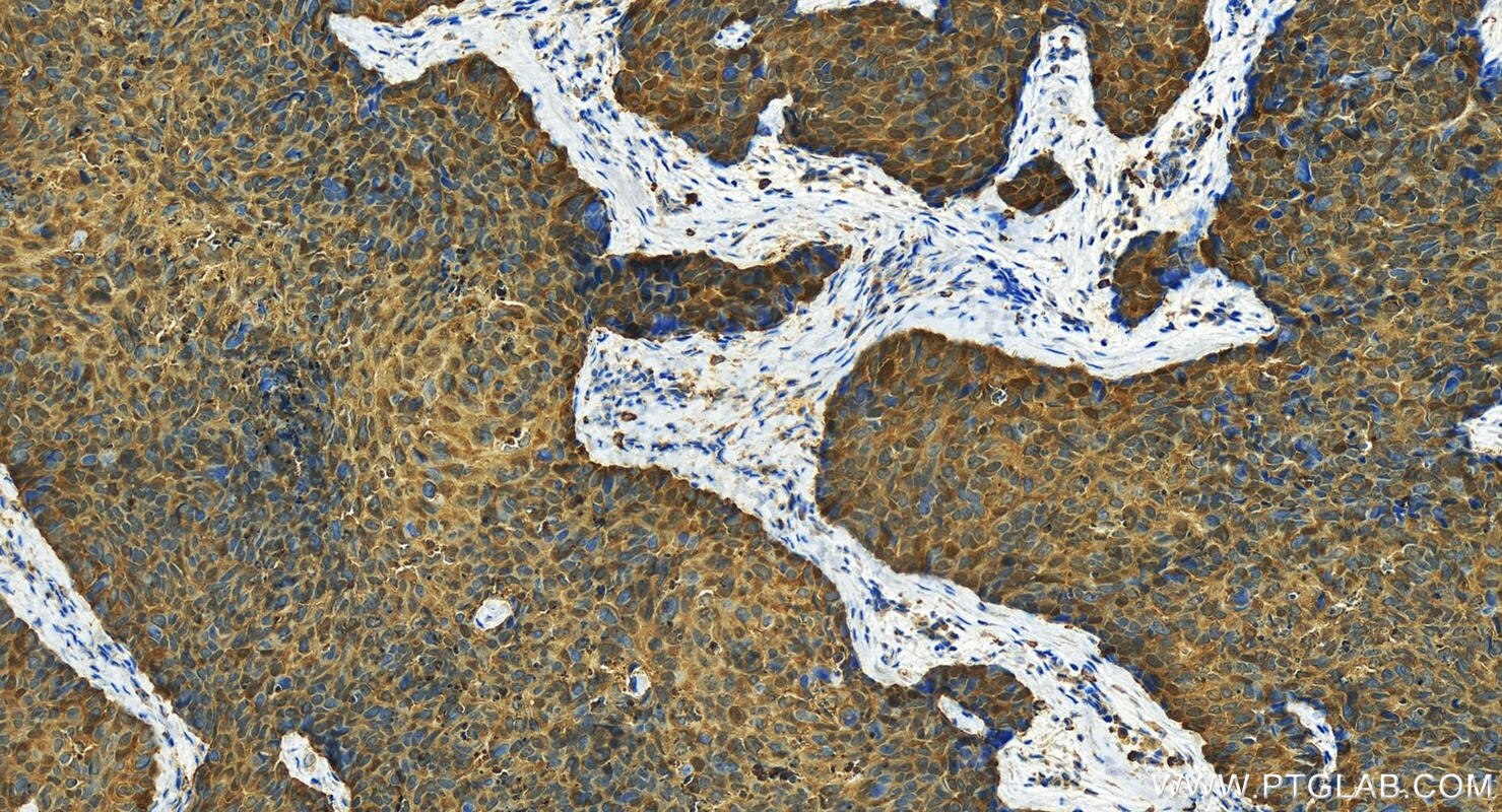Immunohistochemistry (IHC) staining of human bowen disease using S100A2 Polyclonal antibody (15454-1-AP)