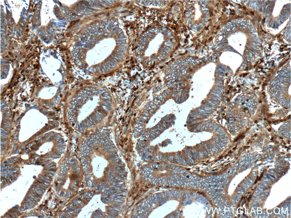 Immunohistochemistry (IHC) staining of human colon cancer tissue using S100A4 Polyclonal antibody (16105-1-AP)