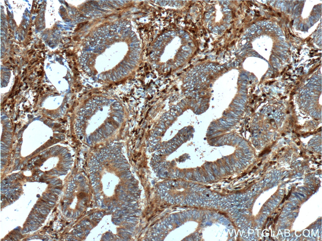 IHC staining of human colon cancer using 16105-1-AP