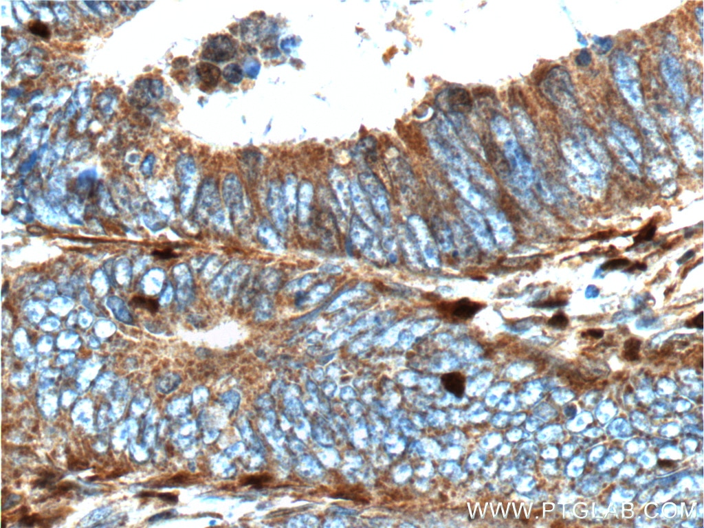 Immunohistochemistry (IHC) staining of human colon cancer tissue using S100A4 Polyclonal antibody (16105-1-AP)