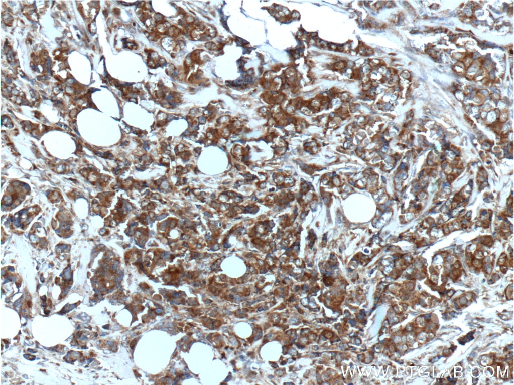 Immunohistochemistry (IHC) staining of human breast cancer tissue using S100A4 Polyclonal antibody (16105-1-AP)