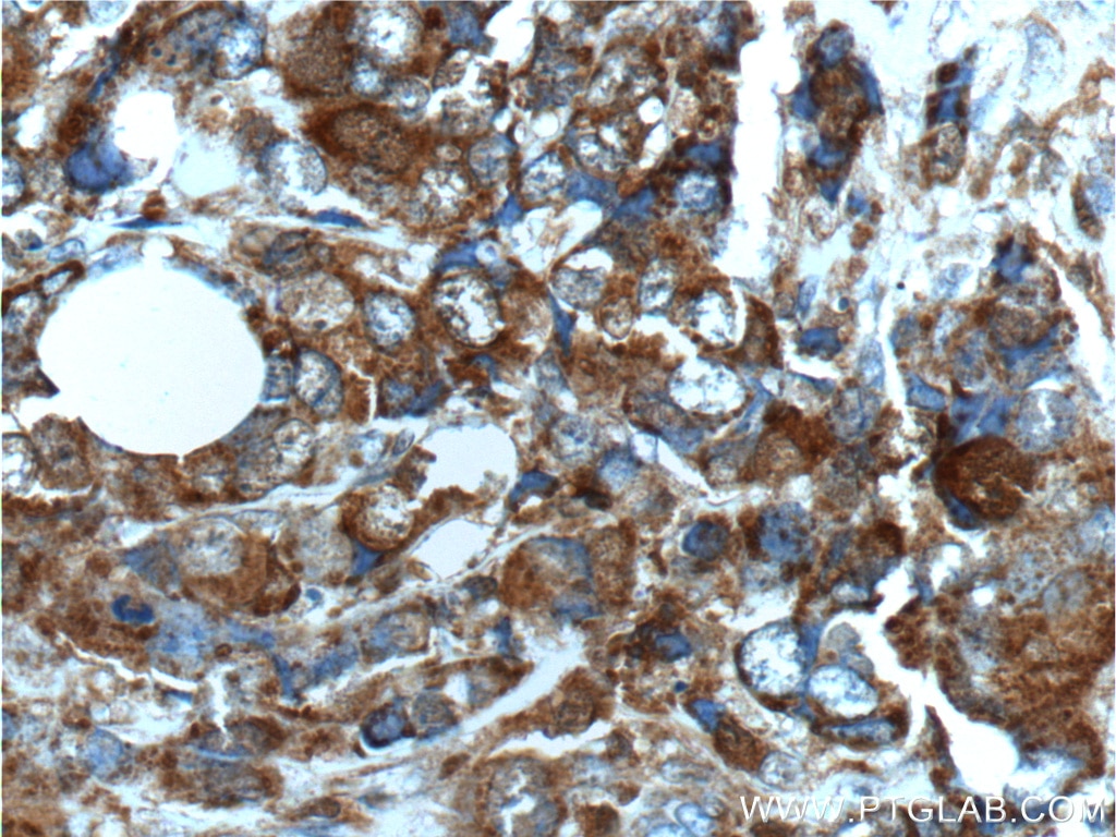 Immunohistochemistry (IHC) staining of human breast cancer tissue using S100A4 Polyclonal antibody (16105-1-AP)