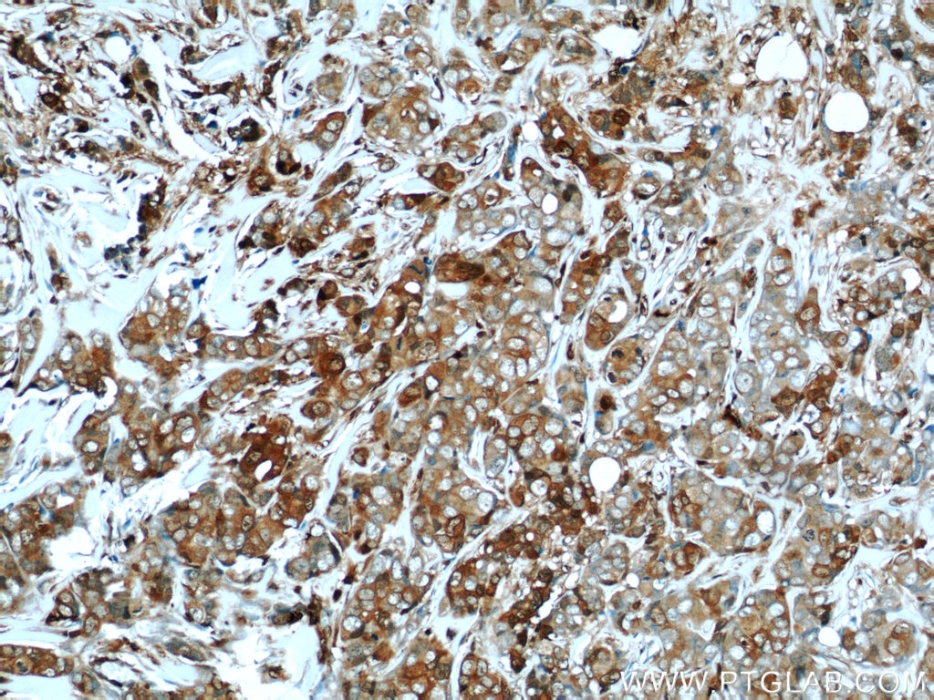 Immunohistochemistry (IHC) staining of human breast cancer tissue using S100A4 Polyclonal antibody (16105-1-AP)