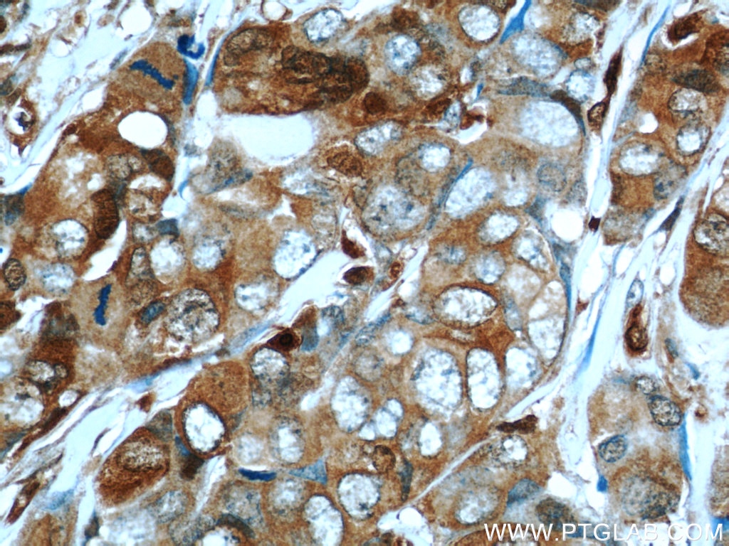 Immunohistochemistry (IHC) staining of human breast cancer tissue using S100A4 Polyclonal antibody (16105-1-AP)