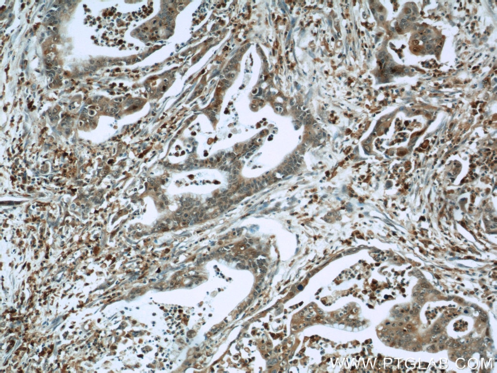 Immunohistochemistry (IHC) staining of human pancreas cancer tissue using S100A4 Polyclonal antibody (16105-1-AP)