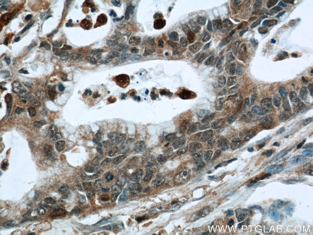 Immunohistochemistry (IHC) staining of human pancreas cancer tissue using S100A4 Polyclonal antibody (16105-1-AP)