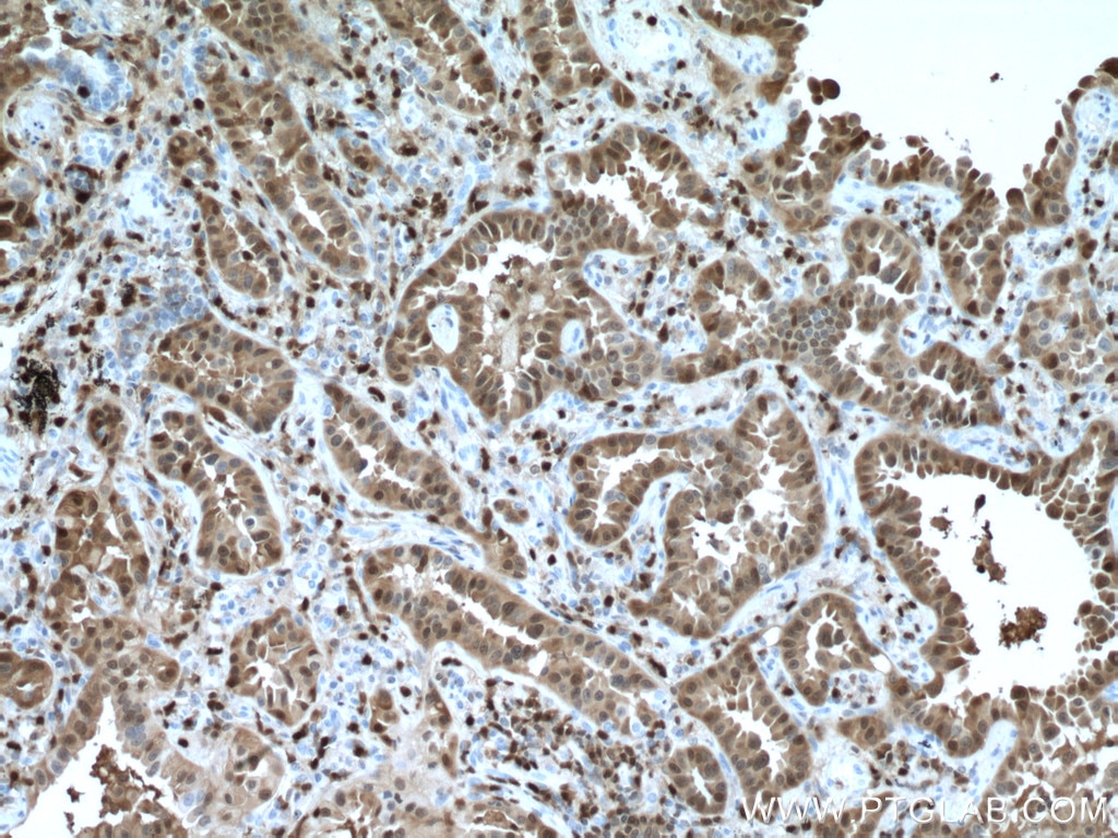 Immunohistochemistry (IHC) staining of human lung cancer tissue using S100A4 Monoclonal antibody (66489-1-Ig)