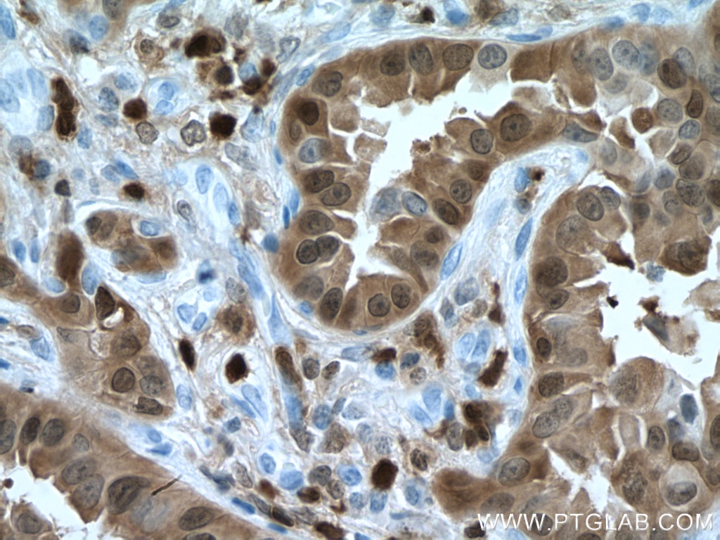 Immunohistochemistry (IHC) staining of human lung cancer tissue using S100A4 Monoclonal antibody (66489-1-Ig)