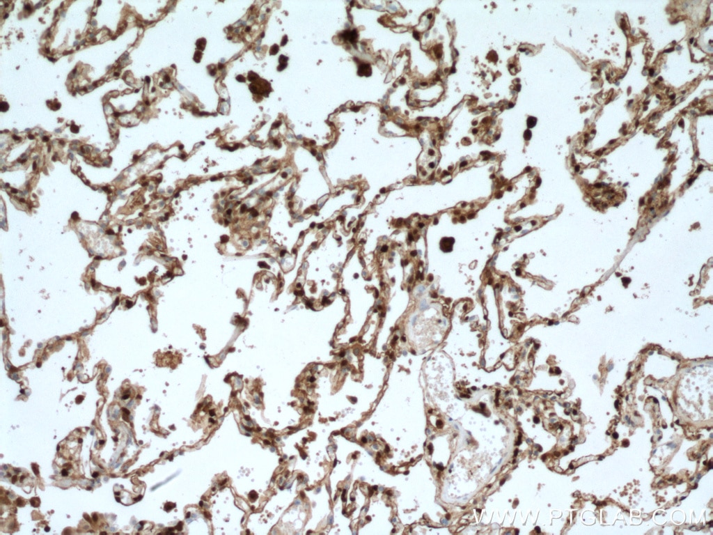 IHC staining of human lung cancer using 66489-1-Ig