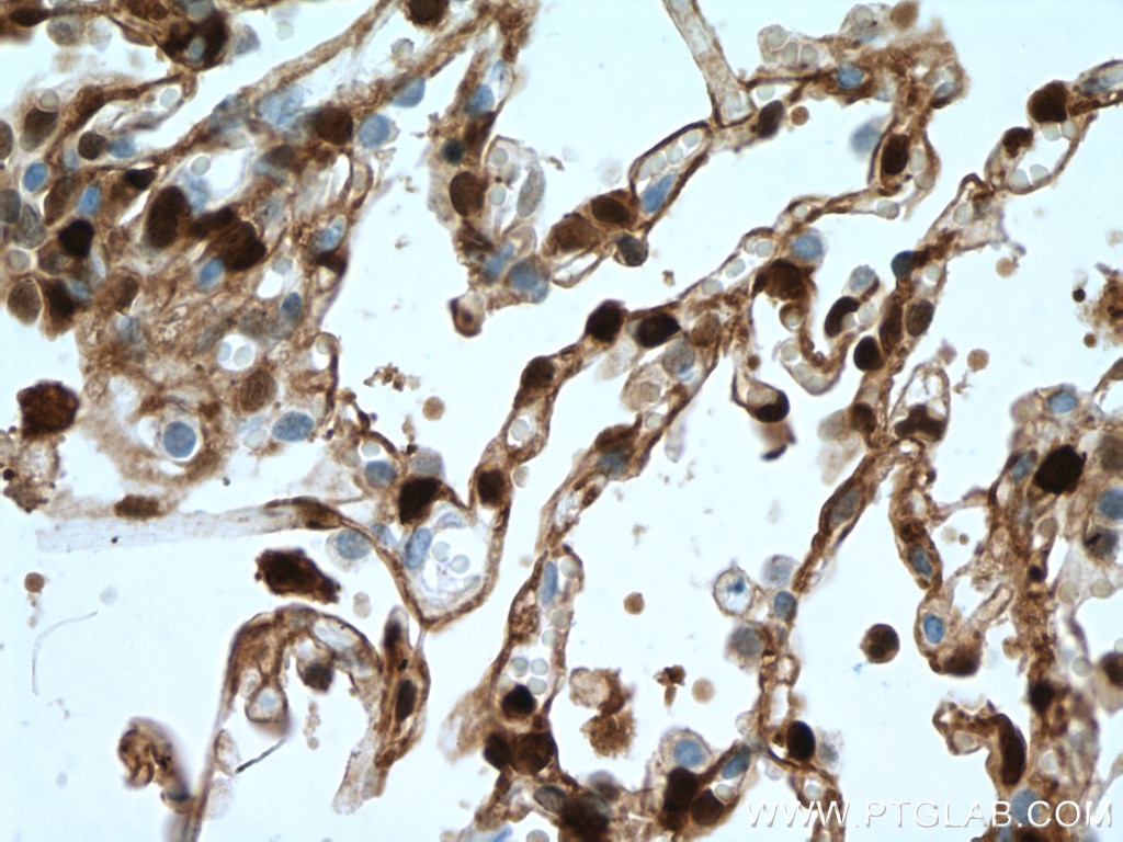 Immunohistochemistry (IHC) staining of human lung cancer tissue using S100A4 Monoclonal antibody (66489-1-Ig)