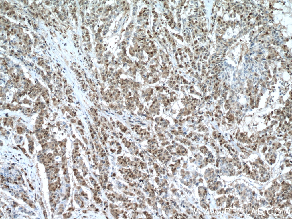 Immunohistochemistry (IHC) staining of human colon cancer tissue using S100A4 Monoclonal antibody (66489-1-Ig)