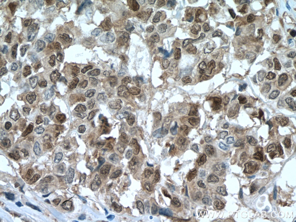Immunohistochemistry (IHC) staining of human colon cancer tissue using S100A4 Monoclonal antibody (66489-1-Ig)