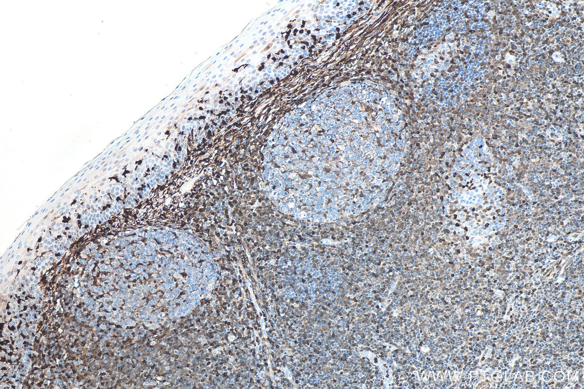 Immunohistochemistry (IHC) staining of human tonsillitis tissue using S100A4 Monoclonal antibody (66489-1-Ig)
