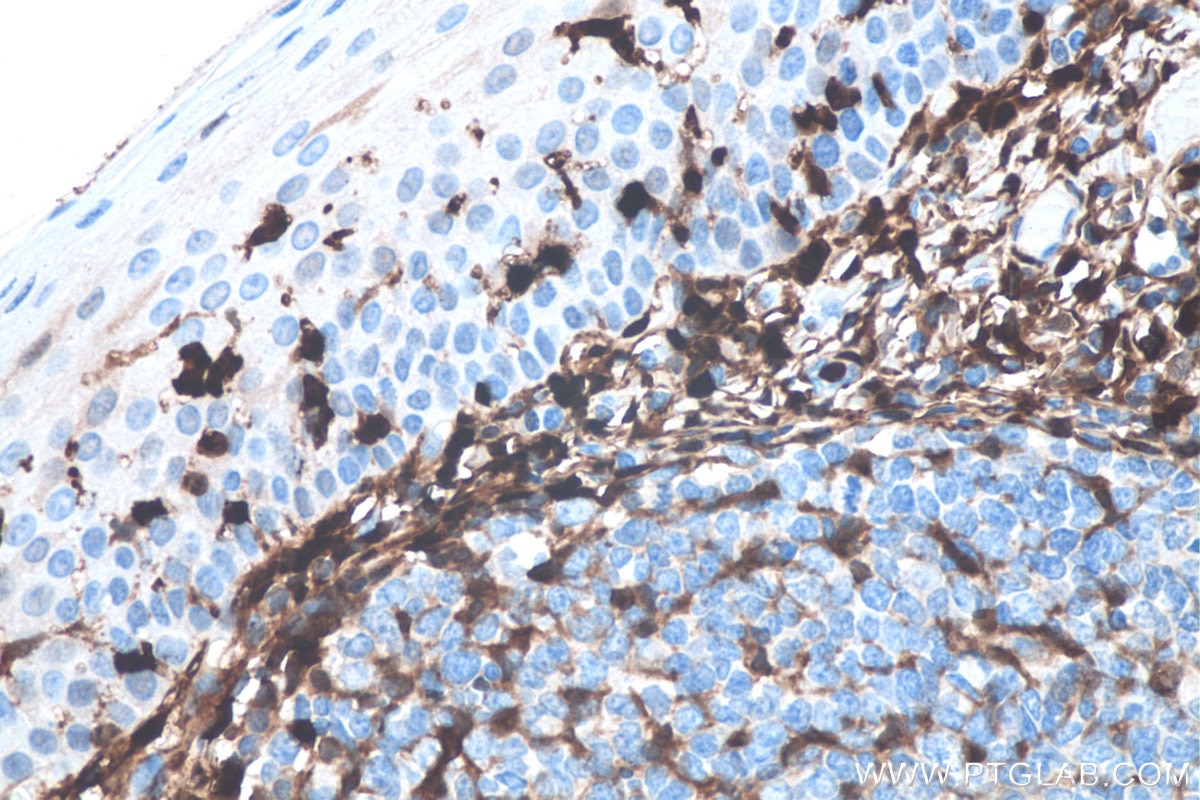 Immunohistochemistry (IHC) staining of human tonsillitis tissue using S100A4 Monoclonal antibody (66489-1-Ig)