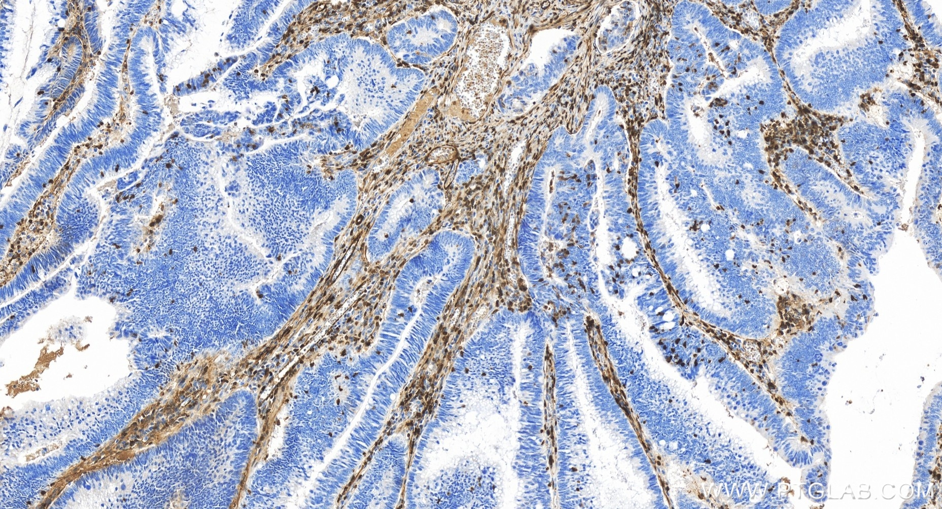 Immunohistochemistry (IHC) staining of human colon cancer tissue using S100A4 Recombinant antibody (84221-1-RR)