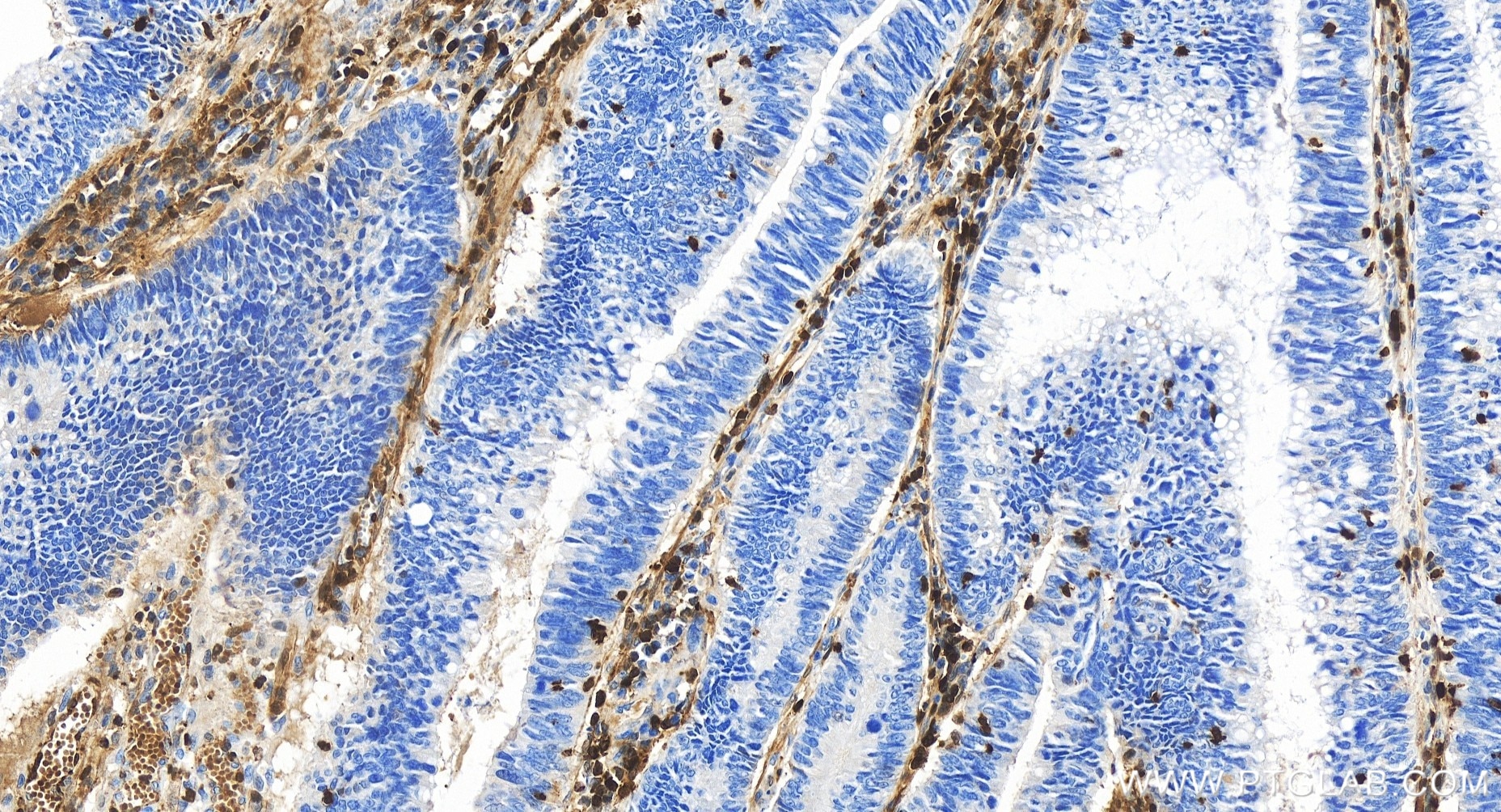 Immunohistochemistry (IHC) staining of human colon cancer tissue using S100A4 Recombinant antibody (84221-1-RR)