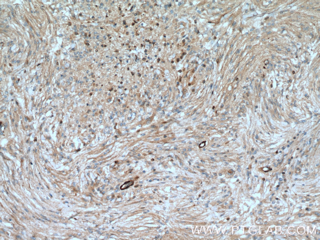 Immunohistochemistry (IHC) staining of human meningioma tissue using S100A5 Polyclonal antibody (17924-1-AP)