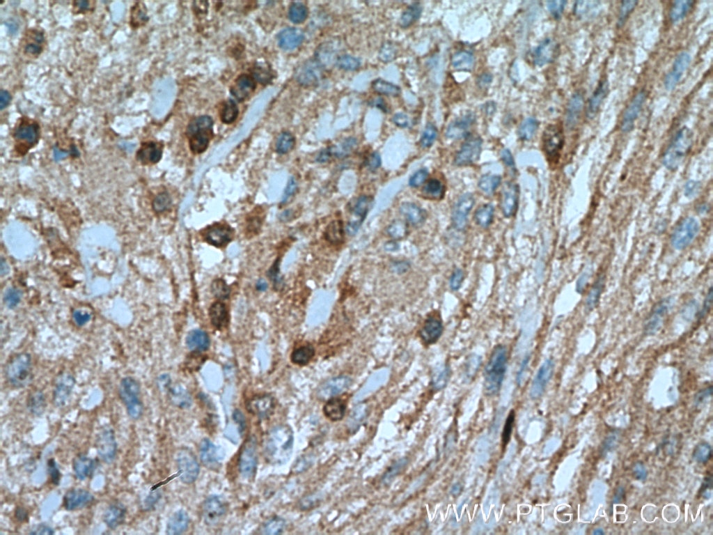 Immunohistochemistry (IHC) staining of human meningioma tissue using S100A5 Polyclonal antibody (17924-1-AP)