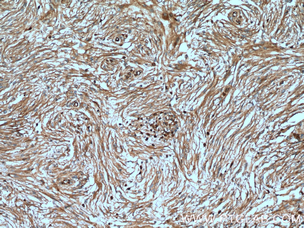 Immunohistochemistry (IHC) staining of human meningioma tissue using S100A5 Polyclonal antibody (17924-1-AP)