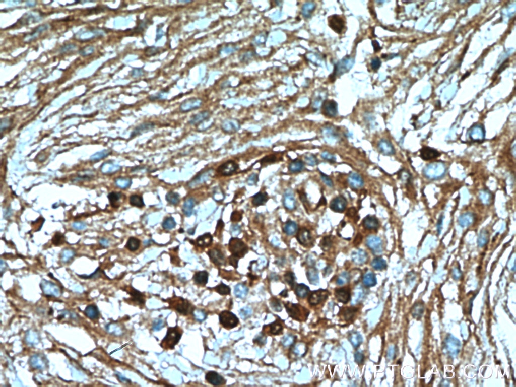 Immunohistochemistry (IHC) staining of human meningioma tissue using S100A5 Polyclonal antibody (17924-1-AP)
