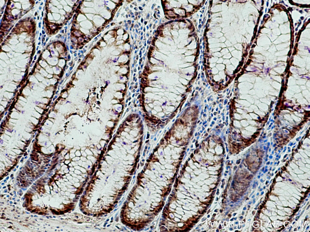 Immunohistochemistry (IHC) staining of human colon cancer tissue using S100A6 Polyclonal antibody (10245-1-AP)