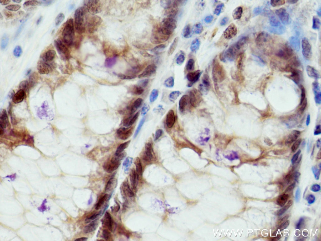 Immunohistochemistry (IHC) staining of human colon cancer tissue using S100A6 Polyclonal antibody (10245-1-AP)