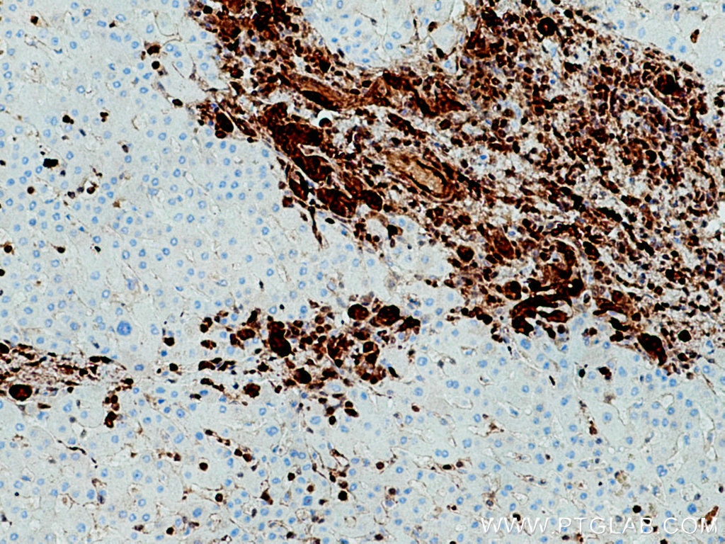 Immunohistochemistry (IHC) staining of human liver cancer tissue using S100A6 Polyclonal antibody (10245-1-AP)