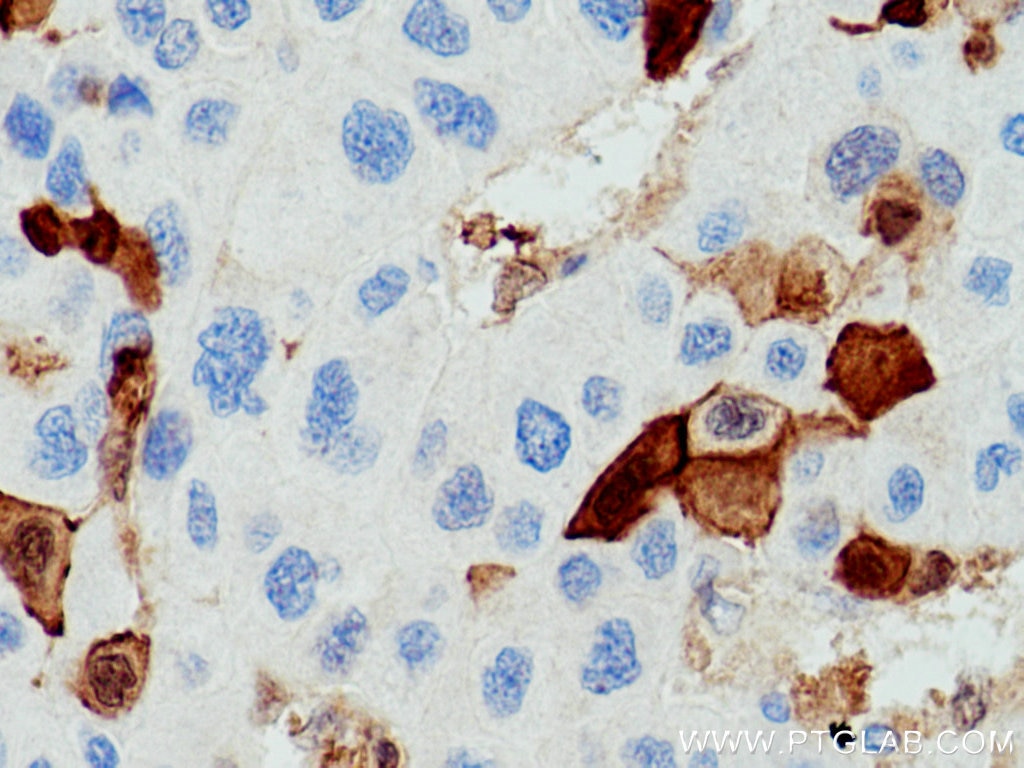 Immunohistochemistry (IHC) staining of human liver cancer tissue using S100A6 Polyclonal antibody (10245-1-AP)