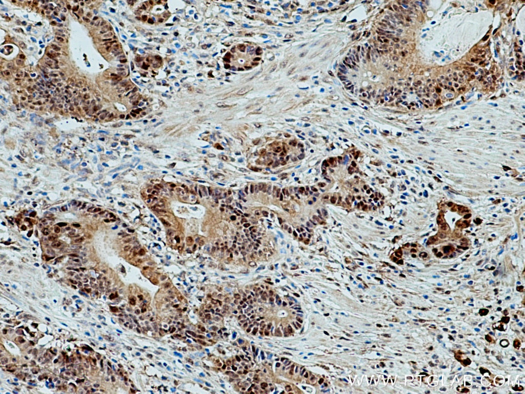 Immunohistochemistry (IHC) staining of human stomach cancer tissue using S100A6 Polyclonal antibody (10245-1-AP)