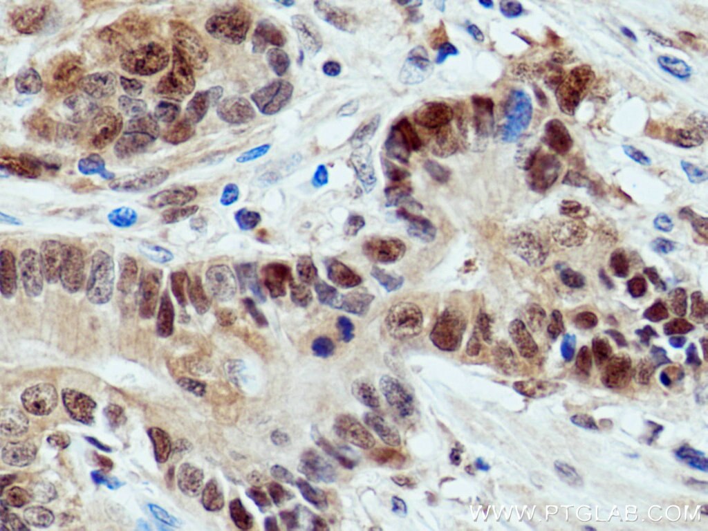 Immunohistochemistry (IHC) staining of human stomach cancer tissue using S100A6 Polyclonal antibody (10245-1-AP)