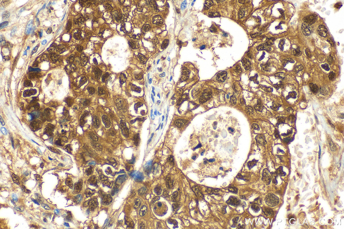 Immunohistochemistry (IHC) staining of human stomach cancer tissue using S100A6 Polyclonal antibody (10245-1-AP)