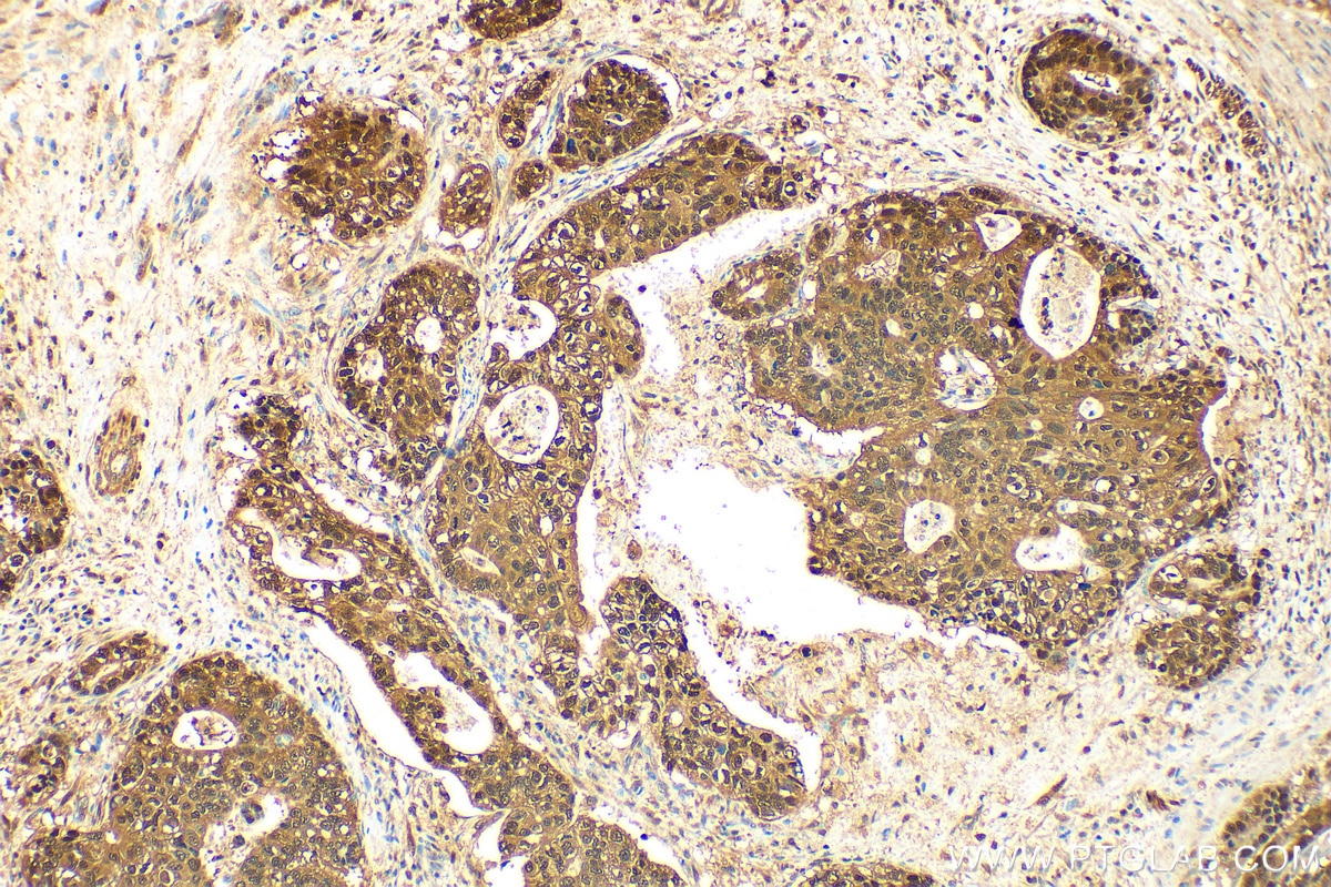 Immunohistochemistry (IHC) staining of human stomach cancer tissue using S100A6 Polyclonal antibody (10245-1-AP)